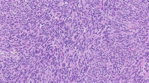 Cellular leiomyoma of the uterus | MyPathologyReport.ca