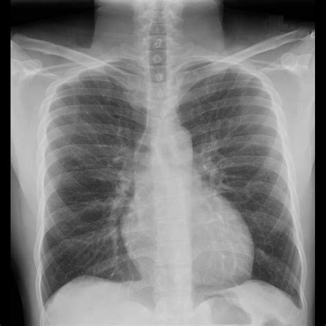 000 Pectus Excavatum | Lungs