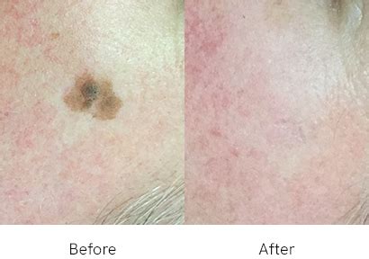 Seborrheic Keratosis | Laser Melbourne