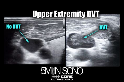 DVT - Core Ultrasound