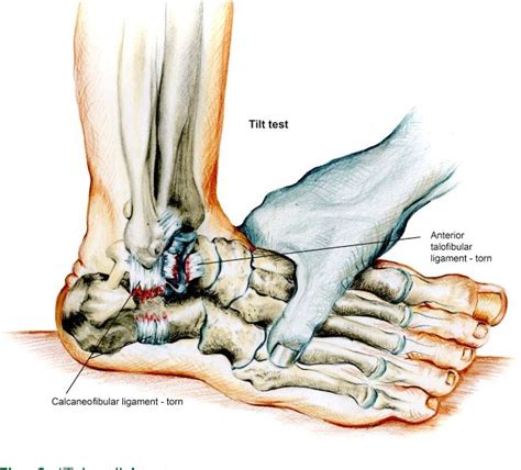 Fig. 8 ‘Talar-tilt’ test. - "Acute ankle sprain: conservative or surgical approach?" | Sprained ...