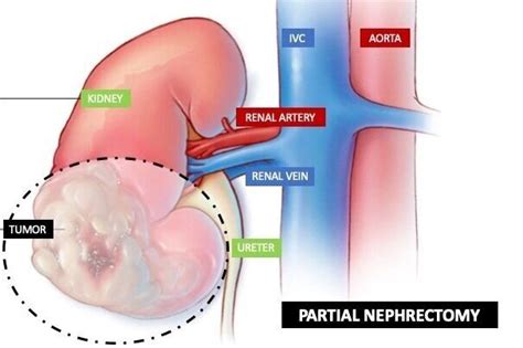 Robotic Partial Nephrectomy — ROBOTIC UROLOGY SANTA BARBARA - Dr Pierre ...