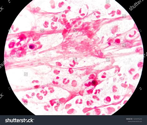 Smear Sputum Specimen Grams Stained Under Stock Photo 1325975243 ...