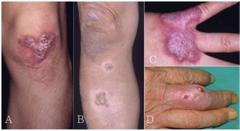 Cutaneous manifestations of Mycobacterium marinum infec | Open-i