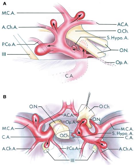 Lateral and Superior Views of Common Aneurysm Sites on the Supraclinoid Portion of the Internal ...