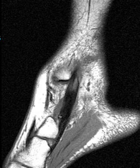 Posterior Tibial Tendinopathy - Radsource