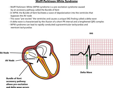 Wolff-Parkinson-White syndrome illustration - EroFound