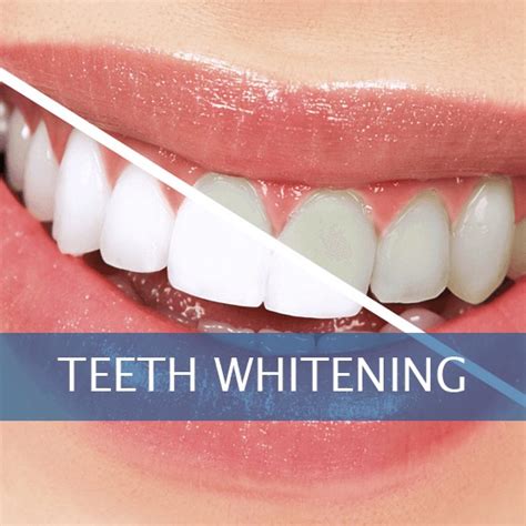 Teeth whitening - Pearl MedSpa