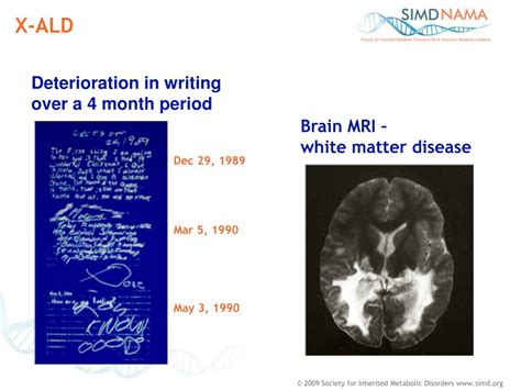 PPT - Disorders of Peroxisome Biogenesis (PBD) PowerPoint Presentation - ID:3351062