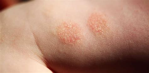Nummular Dermatitis Symptoms Clear Skin Clinic