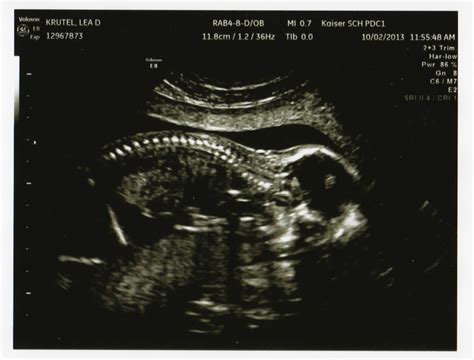 18 Week Ultrasound