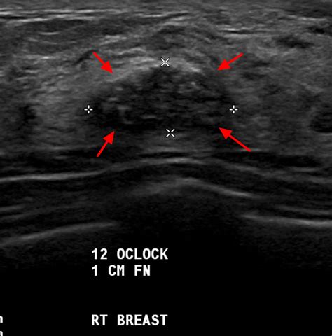 Fibroadenoma - Causes, Symptoms, Diagnosis, Treatment