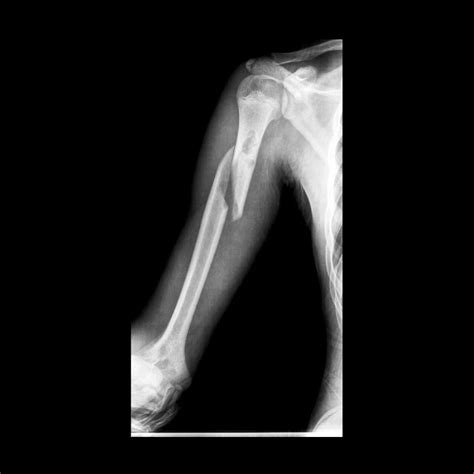 HUMERAL SHAFT FRACTURE | Buyxraysonline