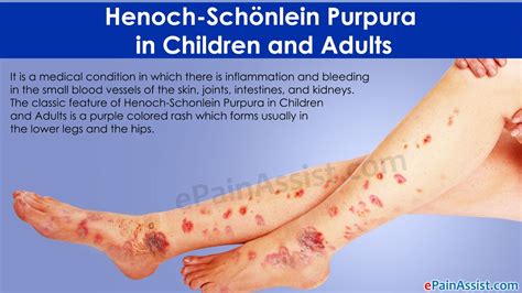 Henoch-Schonlein Purpura (HSP): الأسباب والأعراض والعلاج - الجلد مشاكل ...