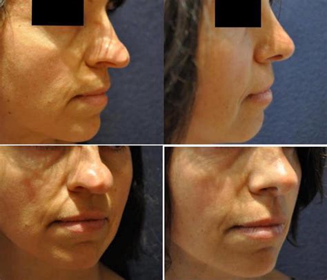 Bulbous Nose Surgery Before After » Rhinoplasty: Cost, Pics, Reviews, Q&A