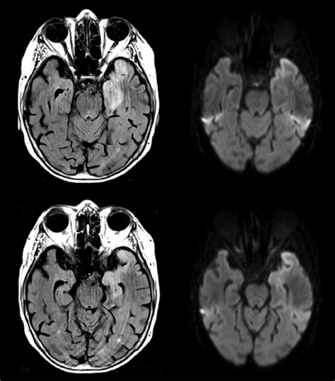 Brain MRI in a patient with encephalitis and positive HSV DNA and... | Download Scientific Diagram