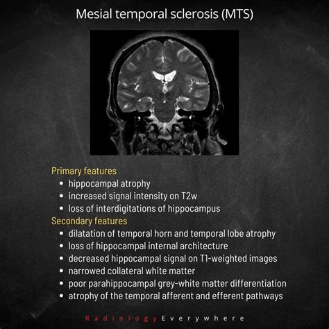 Mesial Temporal Sclerosis (MTS) : r/Radiology