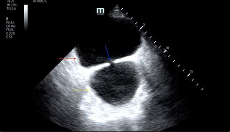 Bladder Diverticulum - A Case Report - JETem