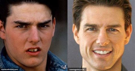 24 Celebrity Pics Before and After Dental Surgery! | Dental cosmetics, Mini dental implants ...