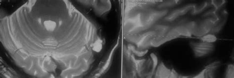 Arachnoid granulations on MRI - Sumer's Radiology Blog