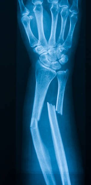 Royalty Free Broken Arm Pictures, Images and Stock Photos - iStock