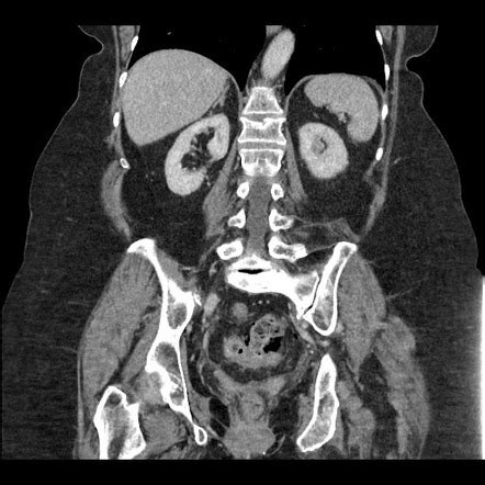 Stercoral colitis with perforation | Radiology Case | Radiopaedia.org