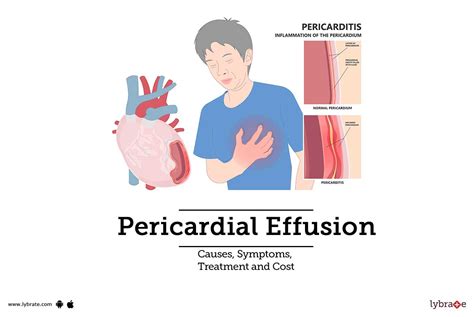 Pericardial Effusion: Causes, Symptoms, Treatment and Cost