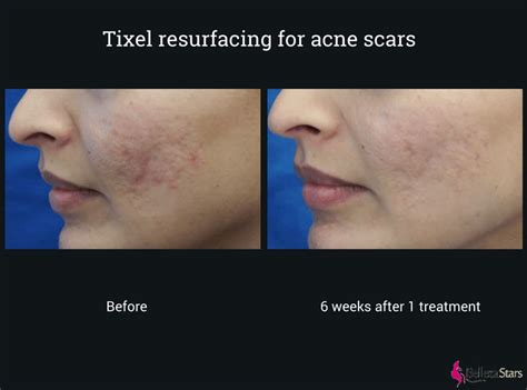 Tixel Fractional Wrinkle Acne Scar Removal Machine BLS1273