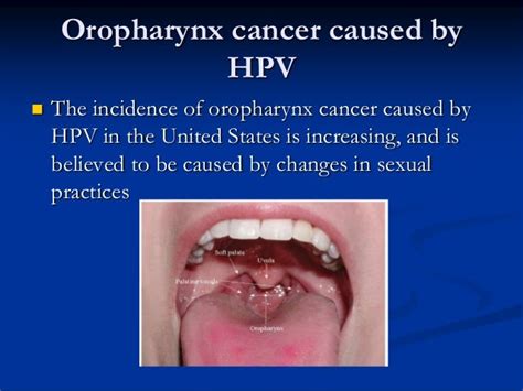 Symptoms Of Head And Neck Cancer Caused By Hpv - CancerWalls