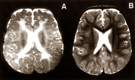 Zellweger syndrome - Pictures, Symptoms, Causes, Treatment