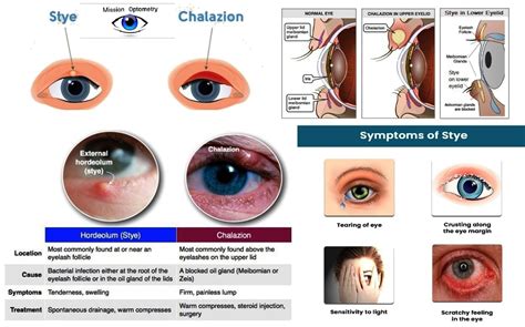 #Stye_vs_Chalazion View in comment box... - Mission Optometry