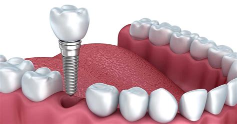 Risks of Dental Implants