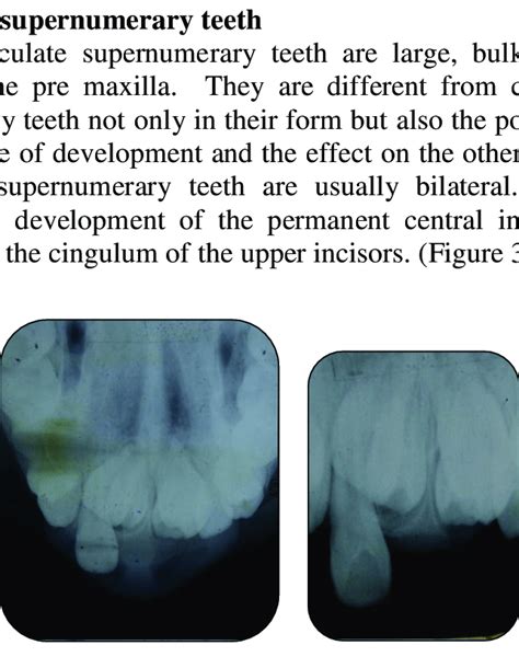 15 Tuberculate supernumerary teeth preventing eruption of central ...