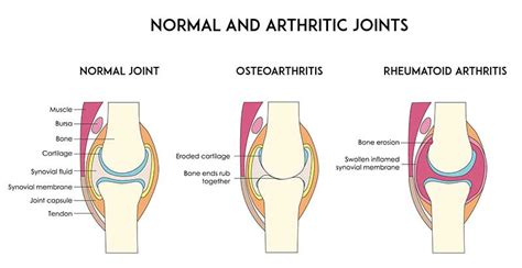 Rheumatoid Arthritis Treatment Kerala | Knee Pain Treatment India