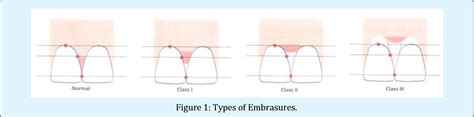 Figure 1 from Interdental Aids-A Literature Review. J Dental Sci 2018, 3(5): 000182 | Semantic ...