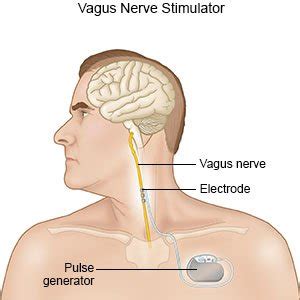 Vagus Nerve Stimulation (Discharge Care)