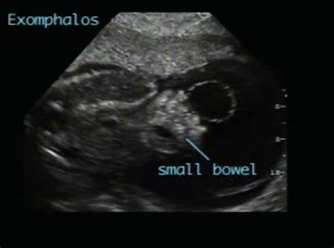 Beckwith-Wiedemann syndrome – ULTRASOUNDPAEDIA