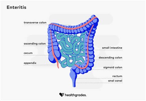 Enteritis - Symptoms, Causes, Tests, and Treatments