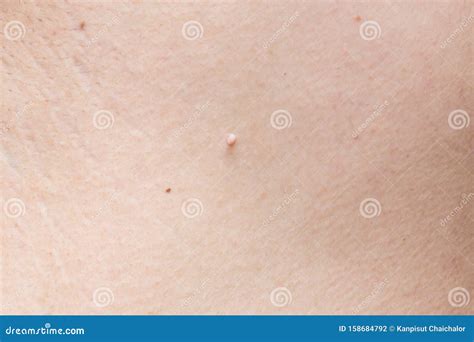 Pedunculated Skin Tag or Acrochondon or Soft Fibroma. Papilloma on Human Skin. Wart Stock Photo ...