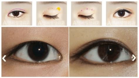 Double Eyelid Surgery in Korea - Definition, Procedure, Benefits, Recovery, Before and After ...