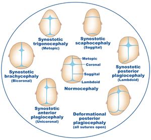 Craniosynostosis | Symptoms, Diagnosis & Treatment