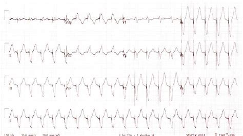 Pacemaker syndrome