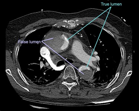 CT Case 006 • LITFL • CT scan interpretation