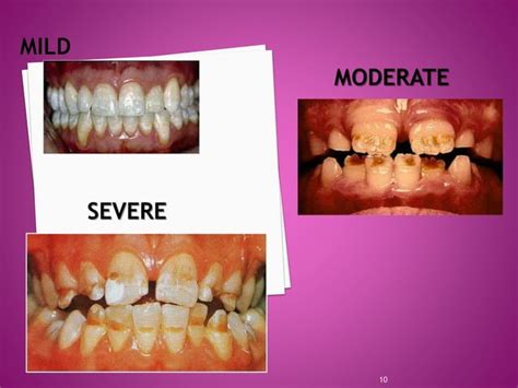 Enamel hypoplasia ppt