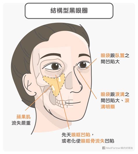 三步驟分出你是哪種黑眼圈！黑眼圈的成因、分類、預防與治療全攻略 | 美的好朋友