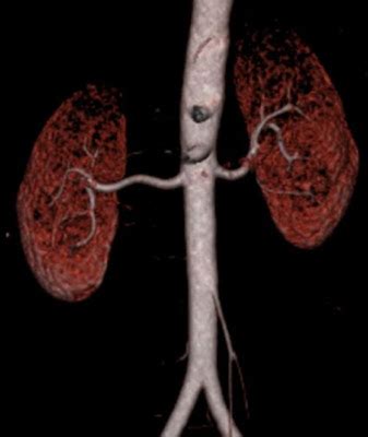 Radiodiagnosis - Imaging is Amazing-Interesting cases: CT Renal angiography - Normal