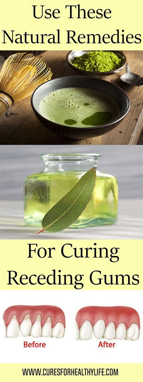 Use These 4 Natural Remedies For Curing Receding Gums # ...
