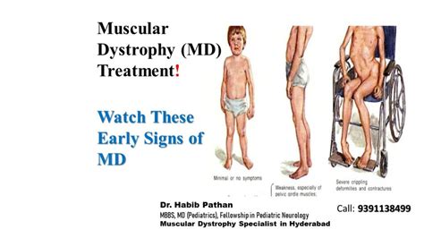 Muscular Dystrophy in Children | Parent's Guide