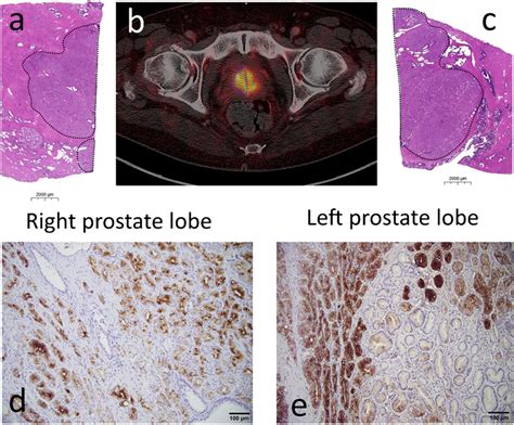 Heterogeneity of PSMA expression in the primary tumor of prostate... | Download Scientific Diagram