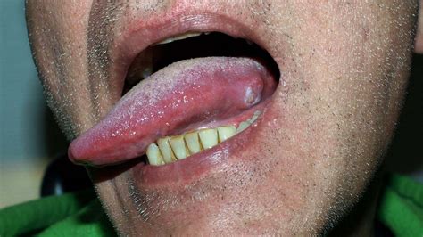 Oral Squamous Cell Carcinoma: Mouth Cancer Symptoms and More